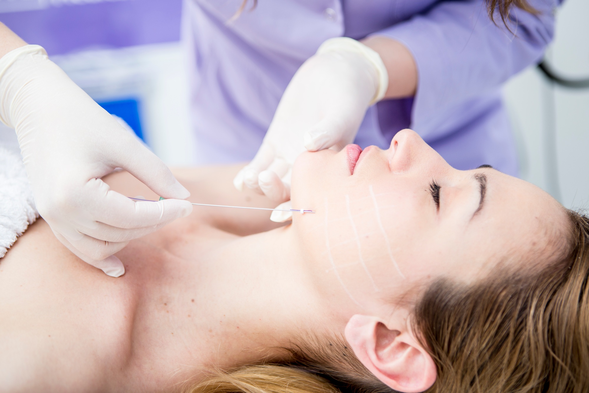 Aesthetic surgery, mesothreads, lifting